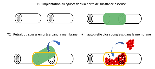 Projet MEMBRAN HIA percy Projet MEMBRAN HIA percy